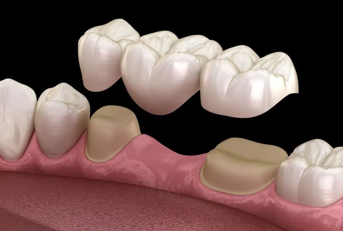 Dental bridges