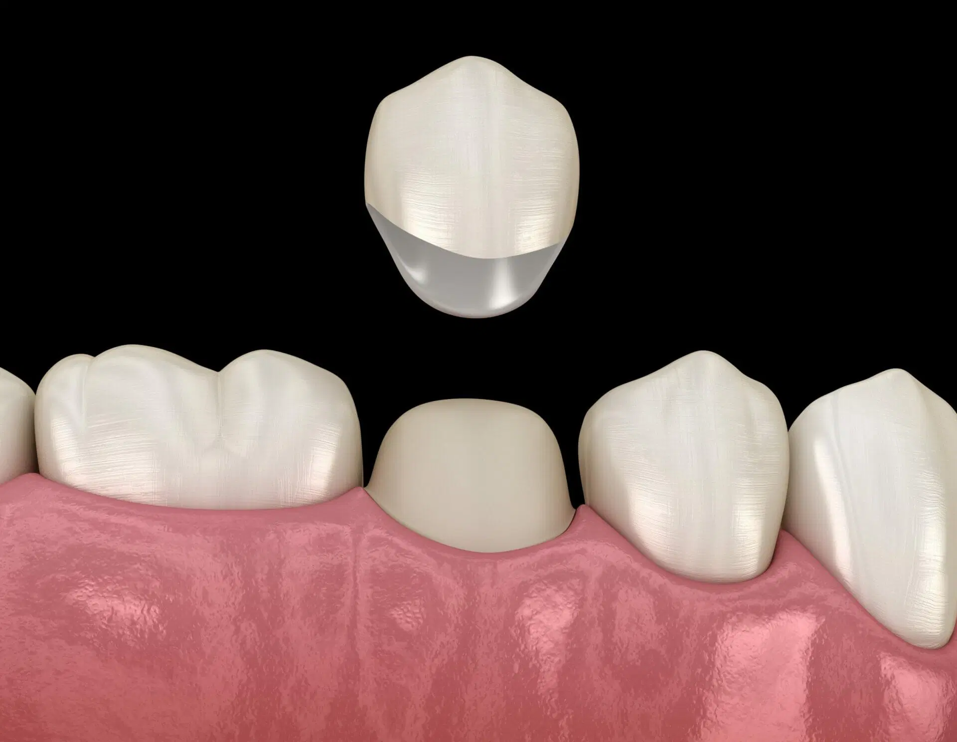 What are dental crowns