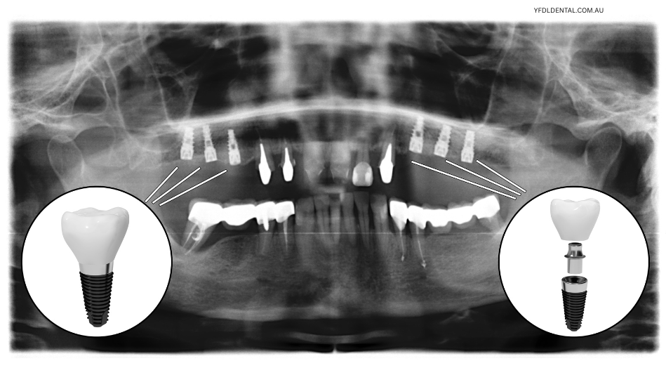 Dental implants at Your Family Dentist Liverpool