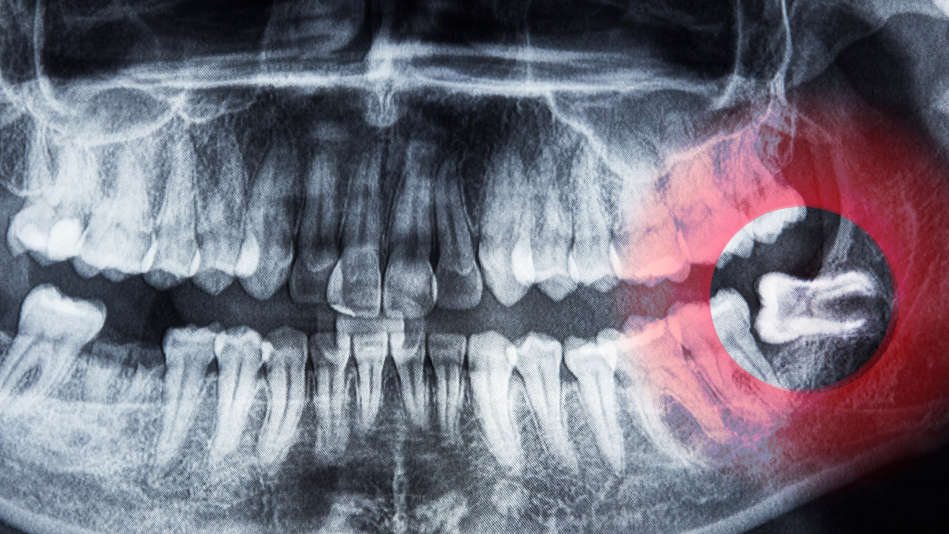Wisdom tooth removal at Your Family Dentist Liverpool