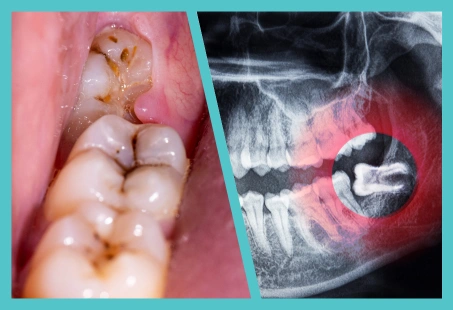 Signs you need wisdom tooth extraction