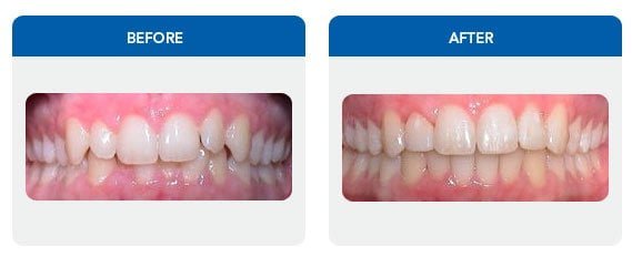 deep-bite-after-sydney.