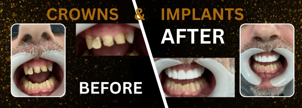 implants and crown