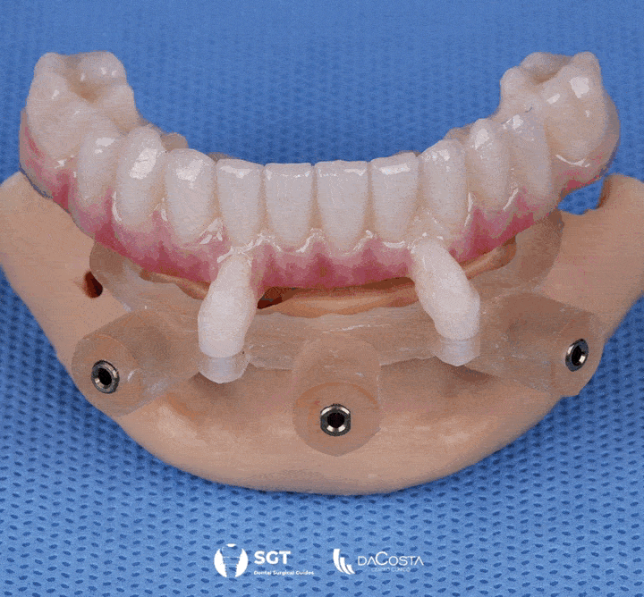 Advanced guided dental implant surgery using 3D imaging for precise implant placement