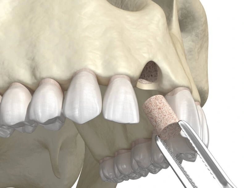 bone graft