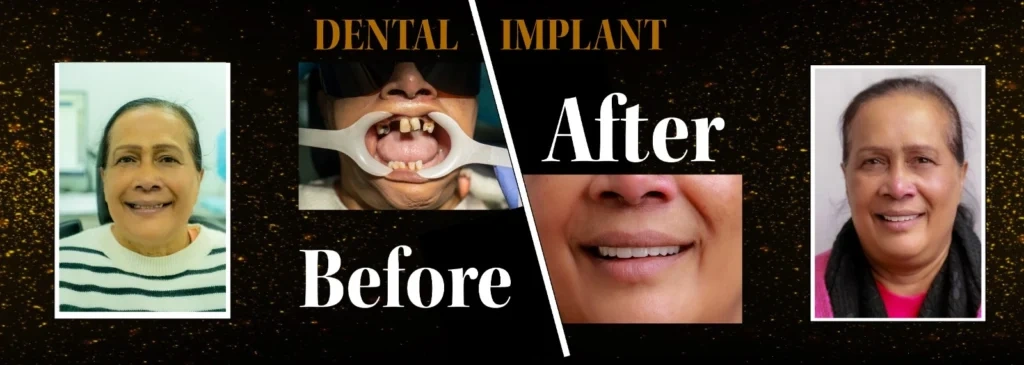 Before and After Dental Implant Service