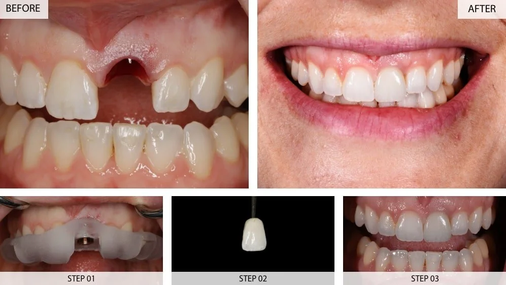 dental implant clinic in sydney