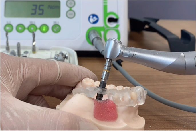 Implant-Supported Bridges