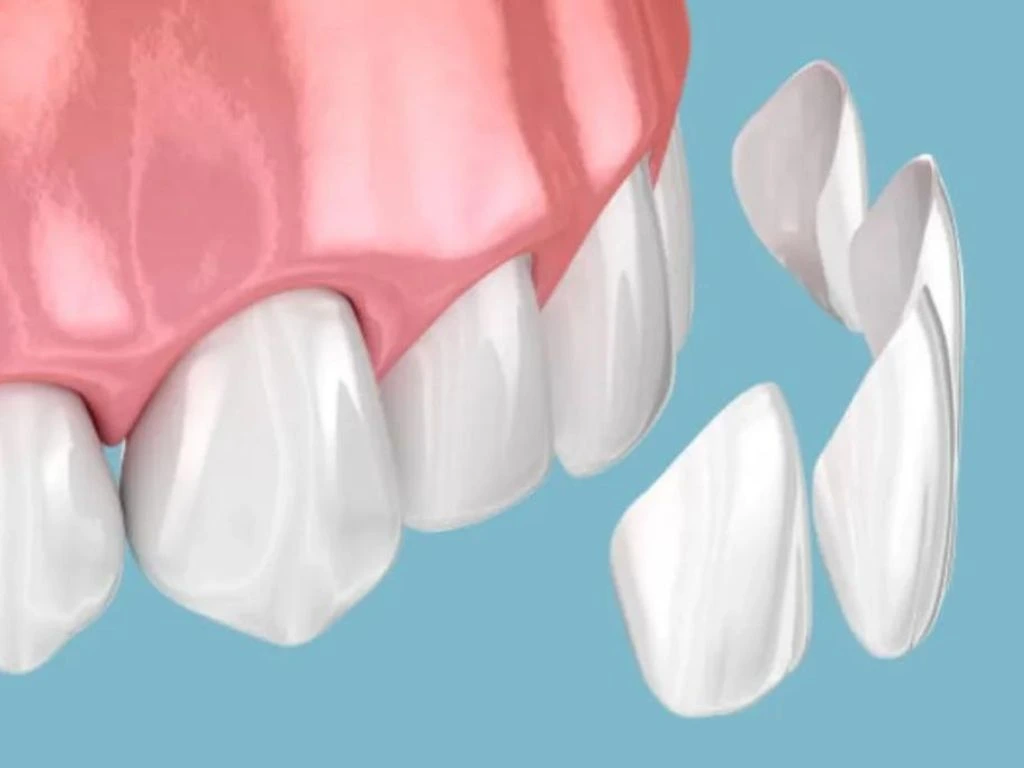 Dental veneers helps to bright your teeth and provides a natural appearance