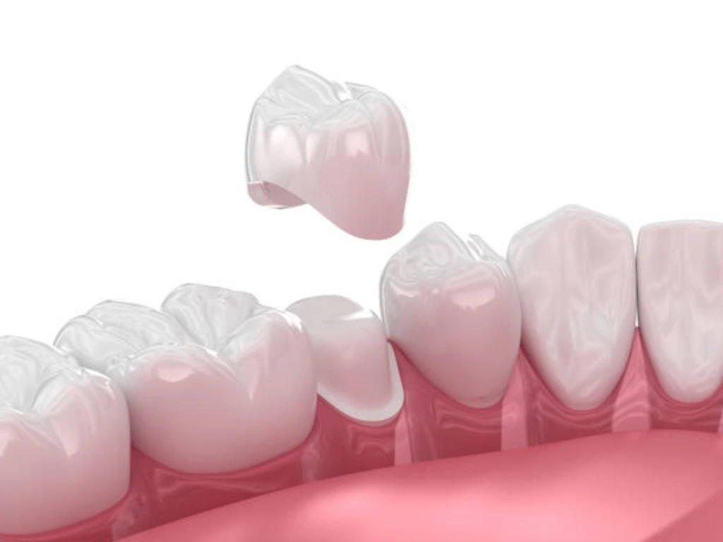 Restore Your Smile with Same Day Crowns at Your Family Dentist know procedure benefits and after tips