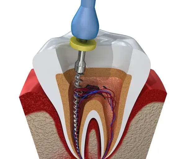 Root canal procedure illustration showing steps of treatment including tooth access pulp removal, and sealing