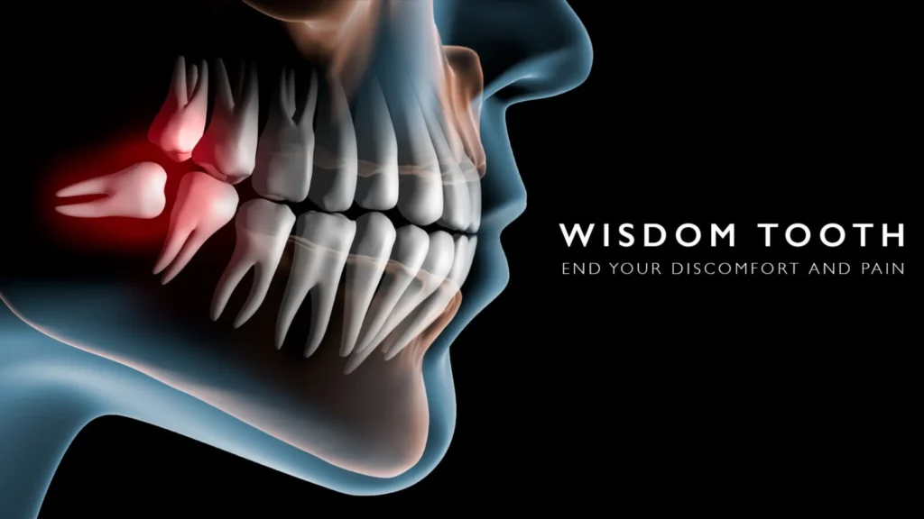 Wisdom Tooth Extraction 5 Dental implants Liverpool clinic — Dr Nick Bhayani