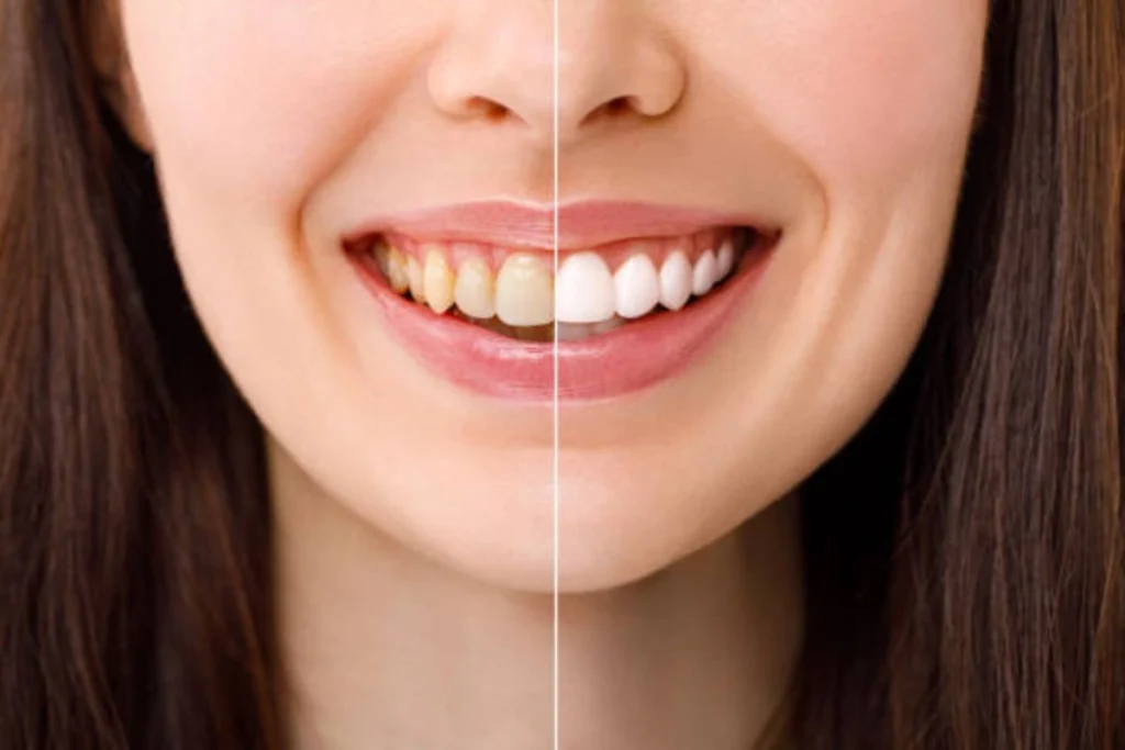 Before and after comparison of teeth whitening results after the teeth whitening procedure showing a brighter smile