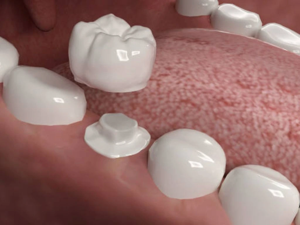 Close-up process of a same day crown being placed on a tooth