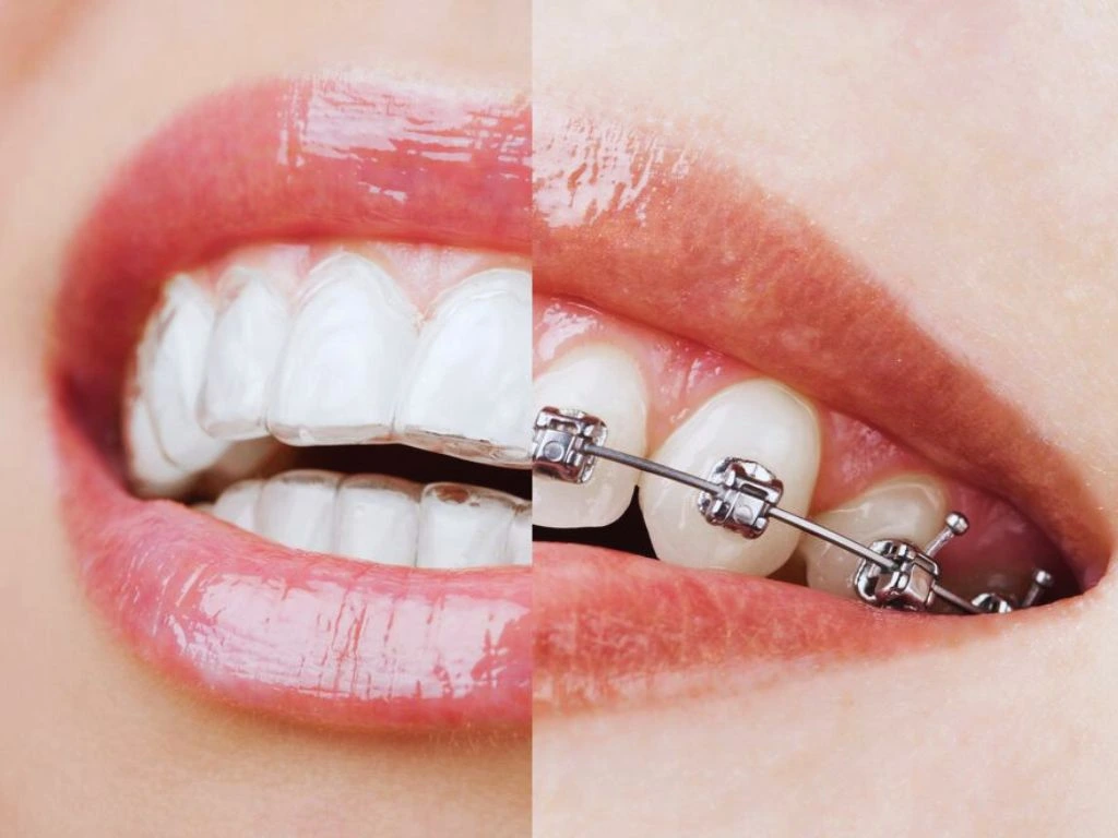 Comparison of Invisalign and Traditional braces treatment options costs and benefits for orthodontic care