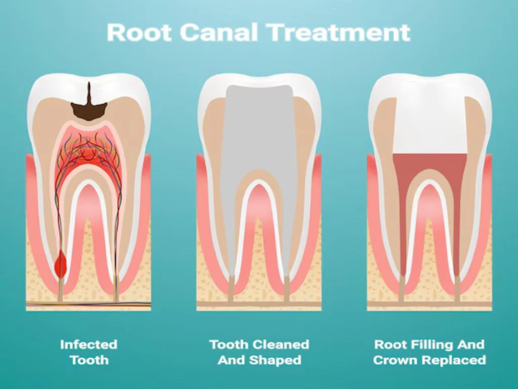 Root canal treatment procedure