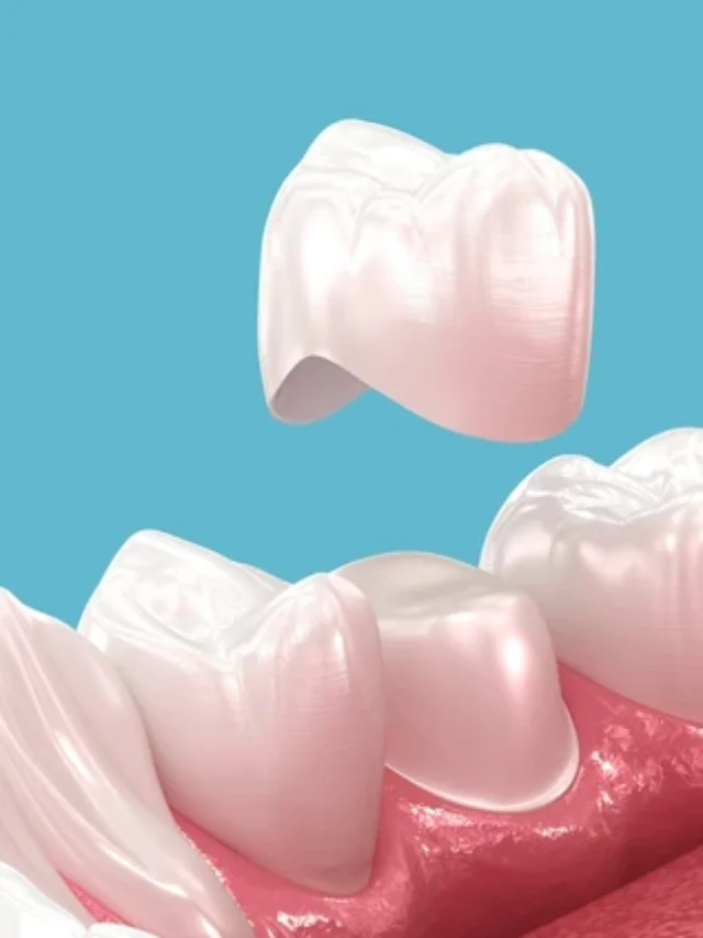 dental-crown-placement-over-tooth-600nw-2473541351
