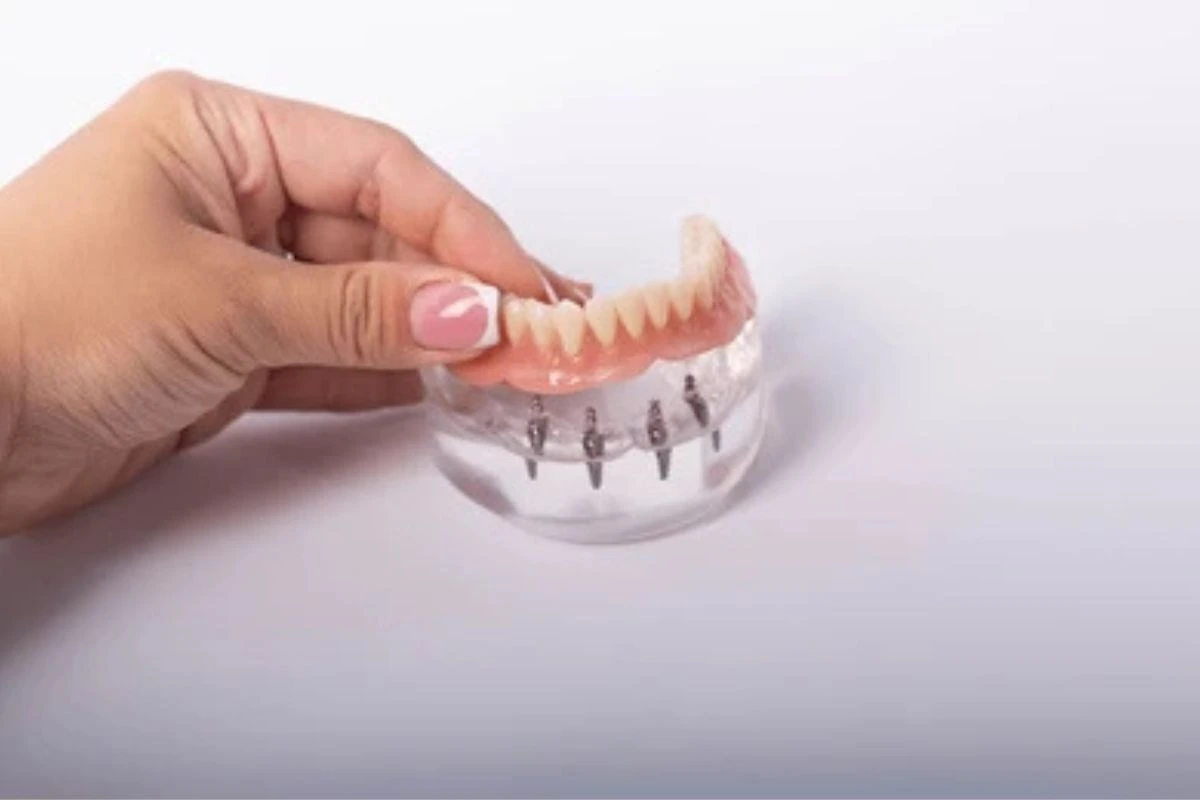 know the process, benefits, and costs of implant supported dentures, featuring a dental professional and a patient discussing treatment options