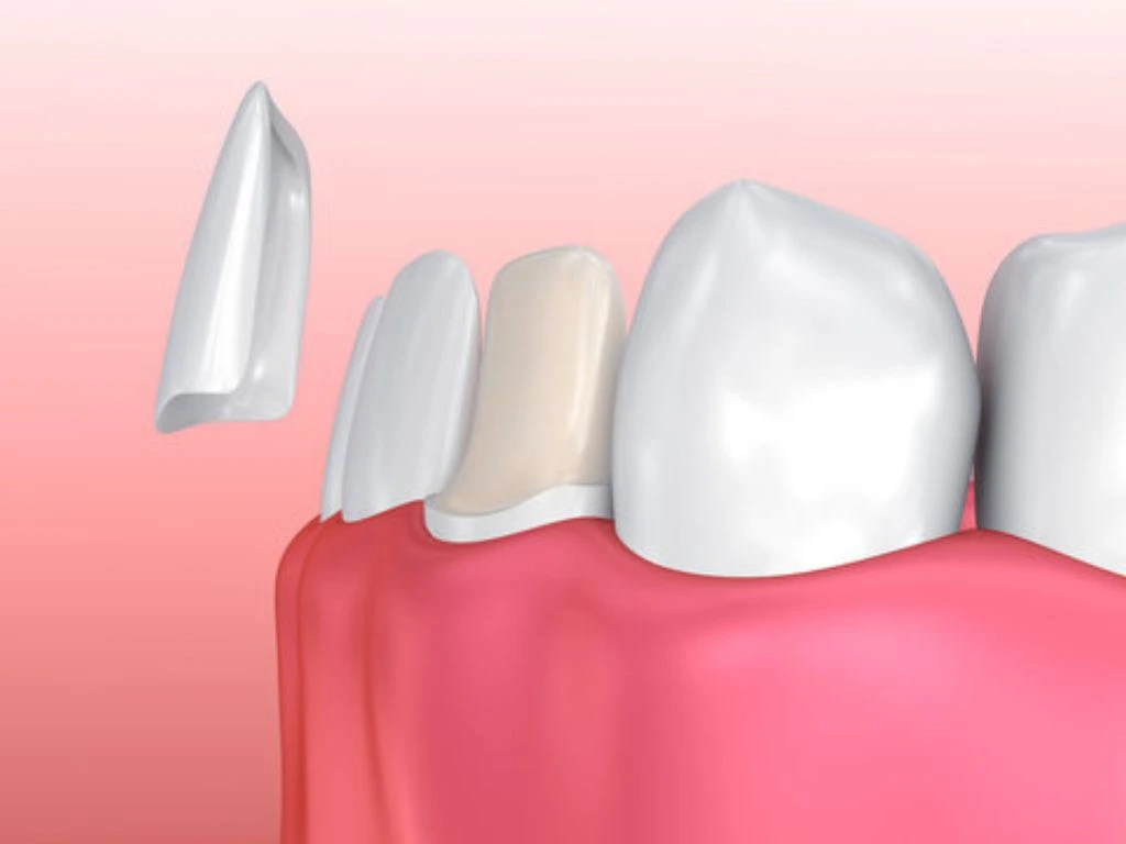 porcelain veneers offers a natural look and shine of enhanced dental aesthetics