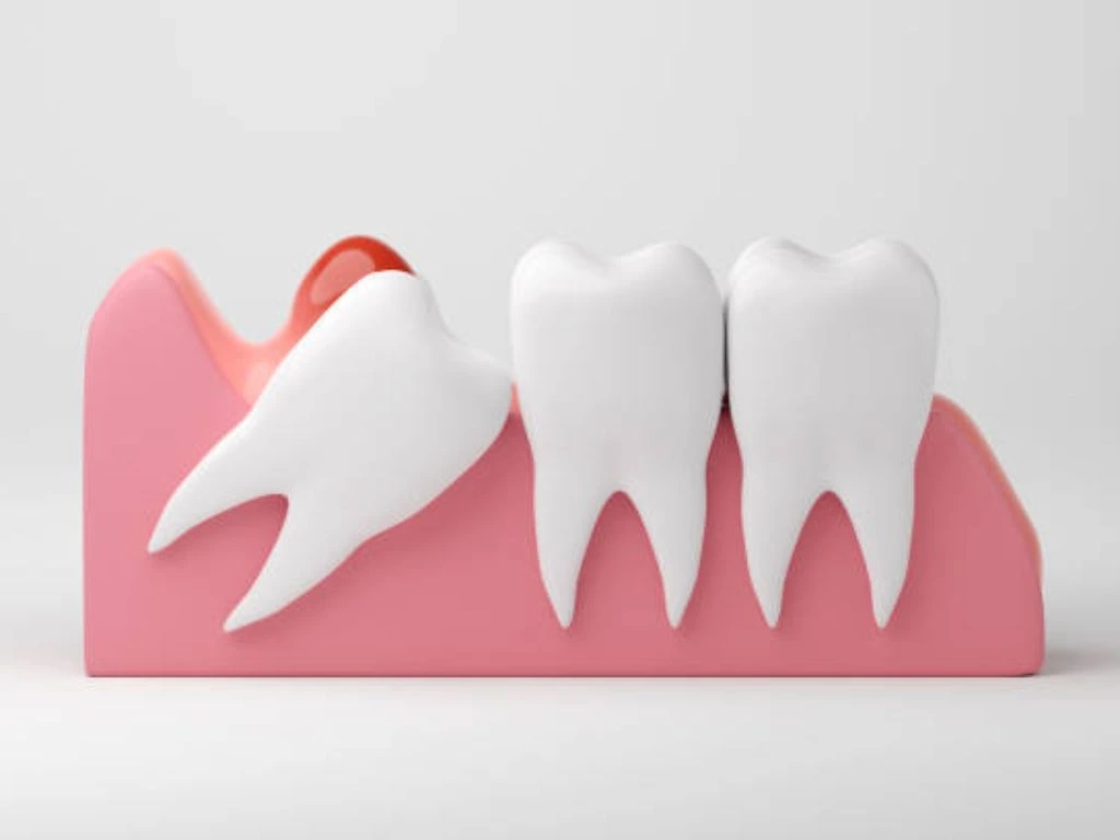 wisdom tooth issues emphasizing the signs that may require extraction.