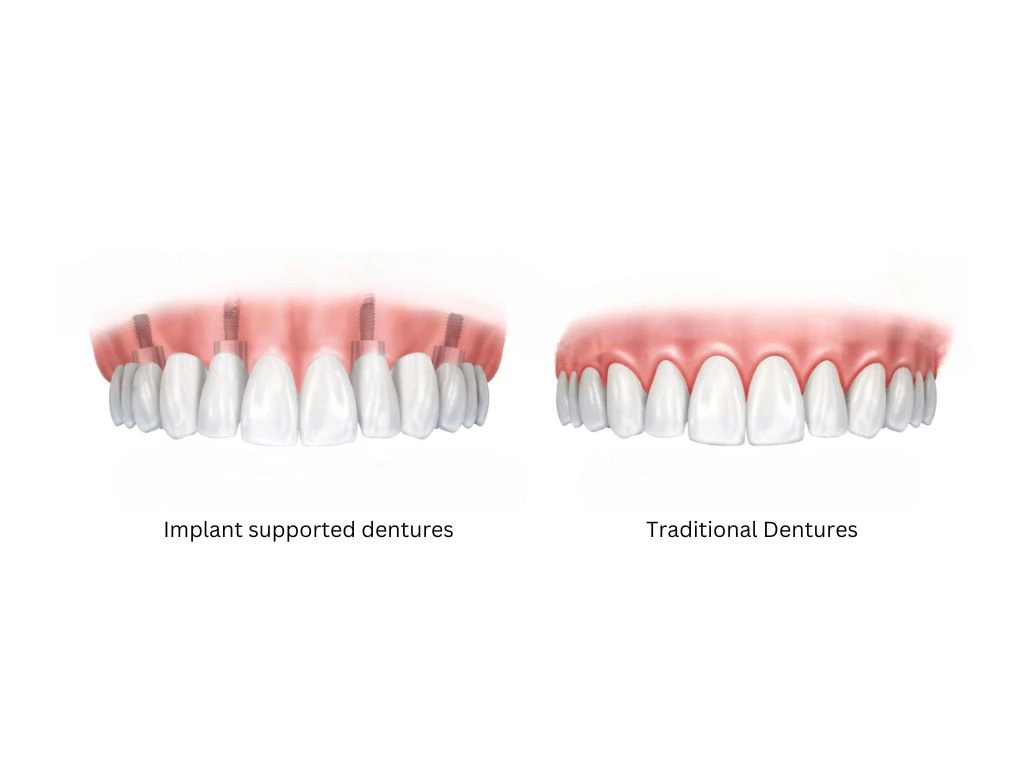 Comparison between implant supported denture and traditional denture showing options for secure and removable dental solutions.