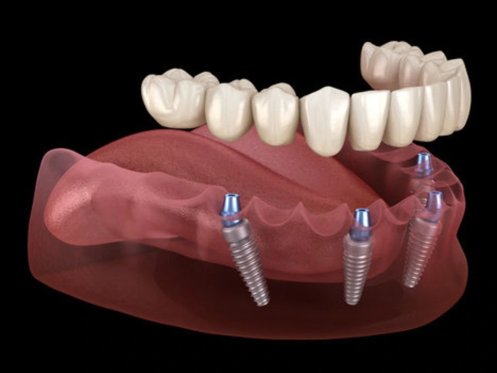 All on Four dental implants for a permanent smile restoration
