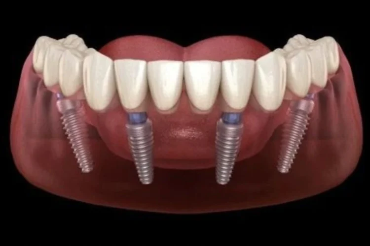 Consider our clinic for Best All on Four dental implants in Liverpool NSW