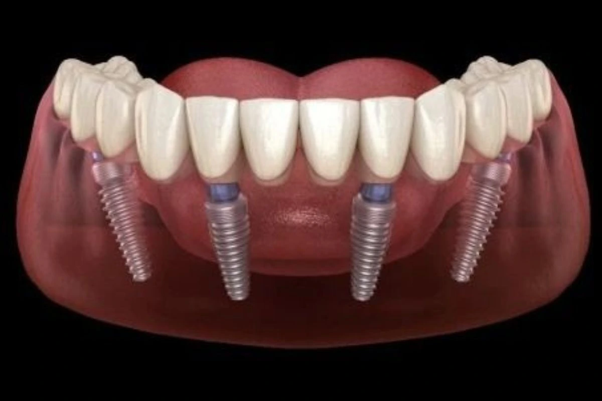 Consider our clinic for Best All on Four dental implants in Liverpool NSW