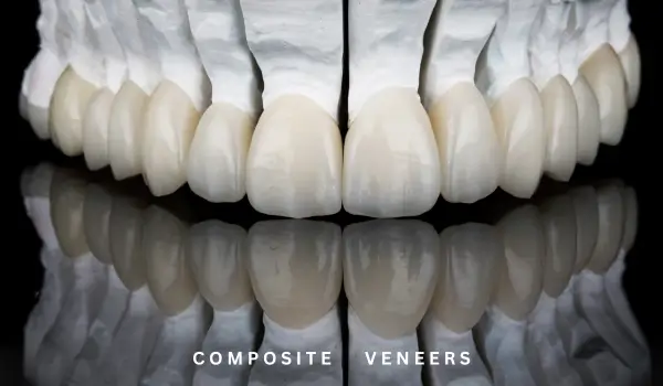 Composite veneers for perfect smile