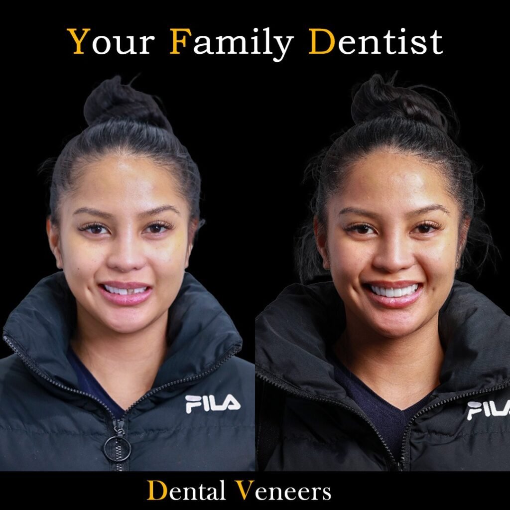 Dental Veneers