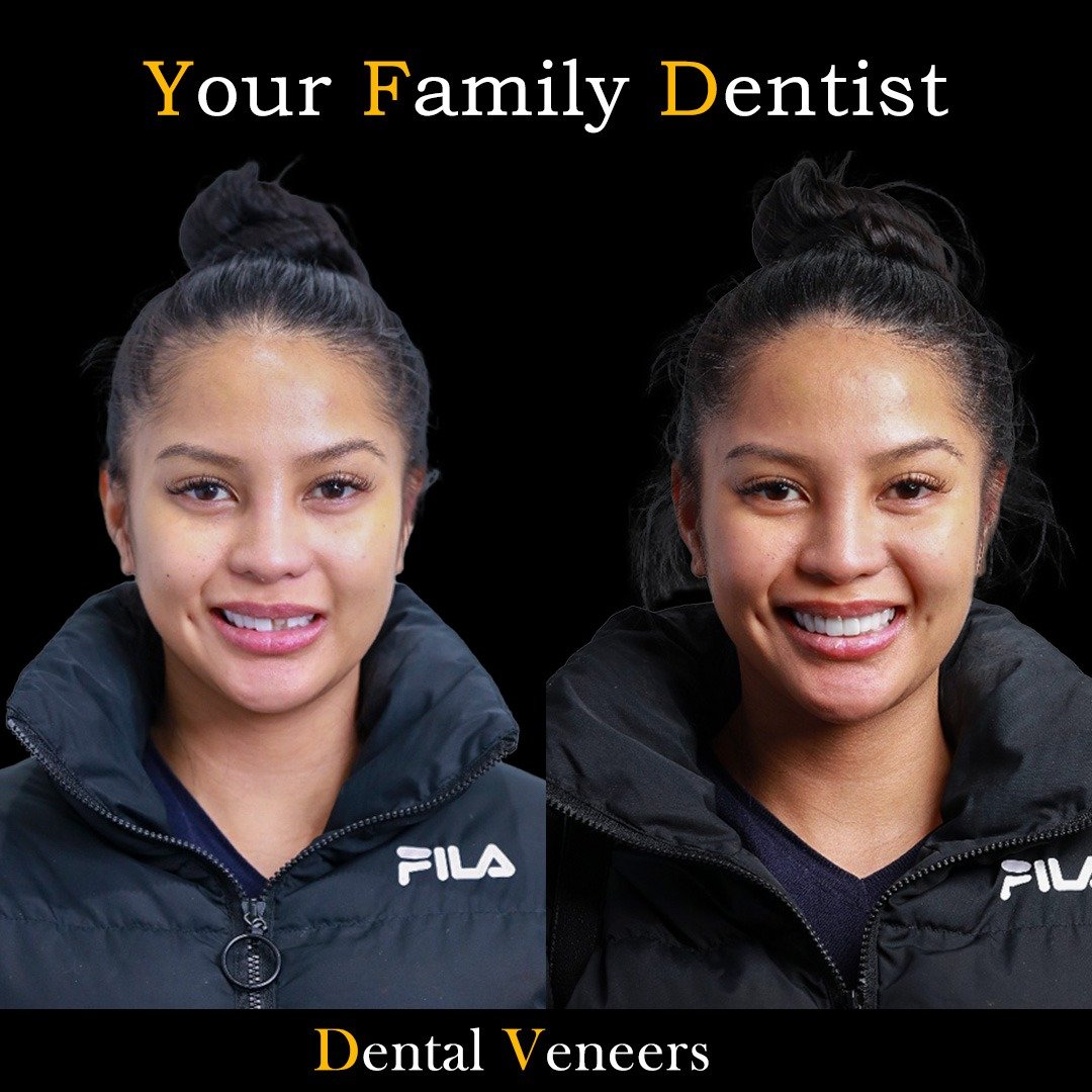 Dental Veneers
