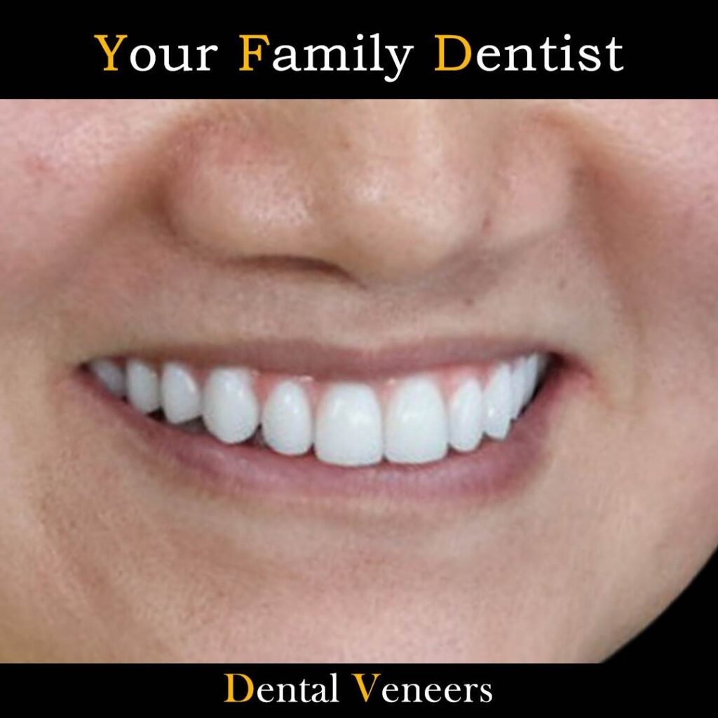Dental Veneers