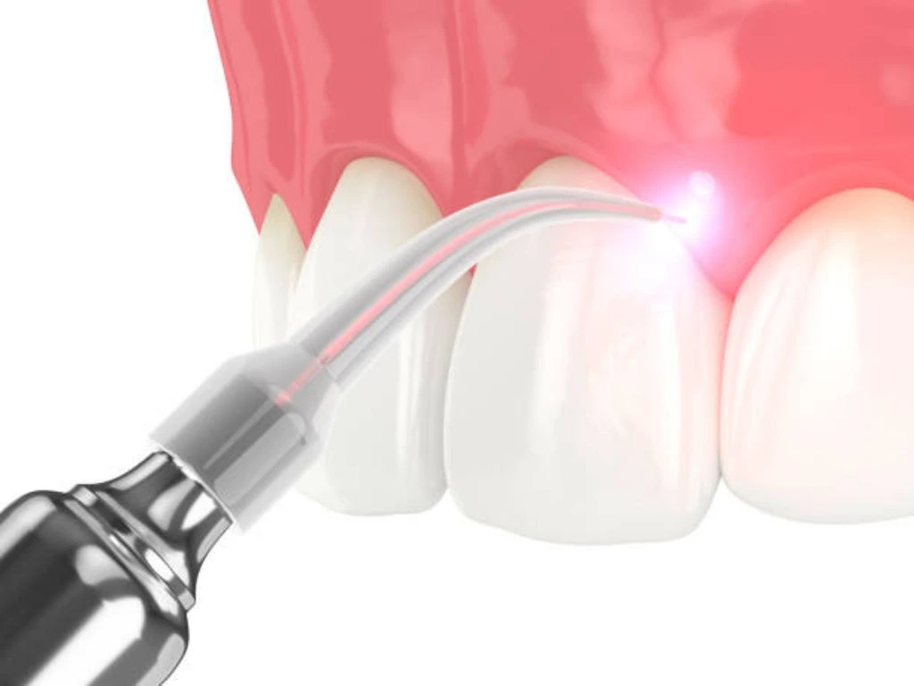 Laser Dentist Liverpool offering painless laser dental treatment