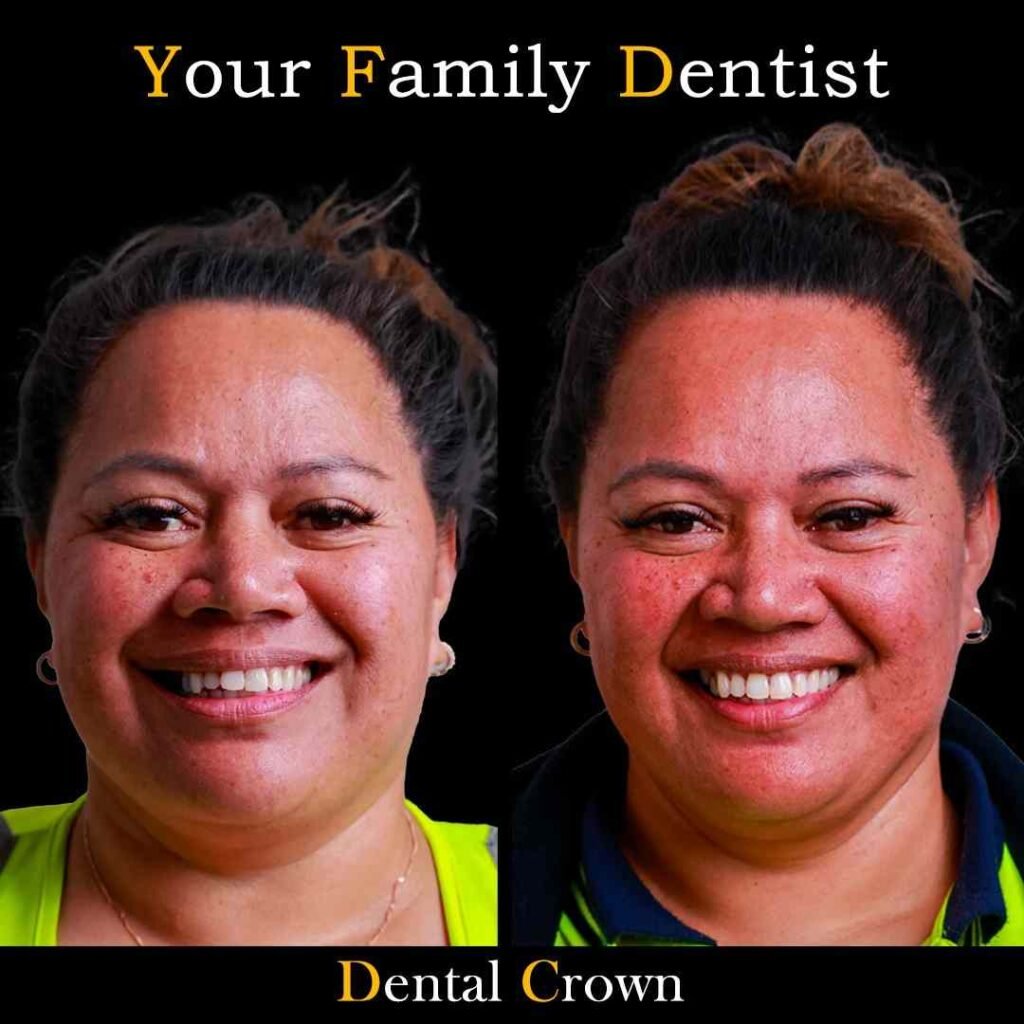 Dental Crown
