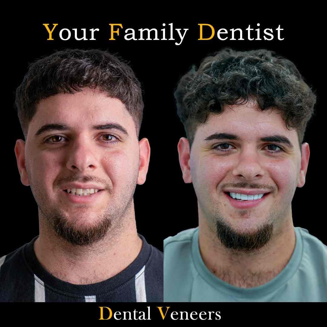veneers