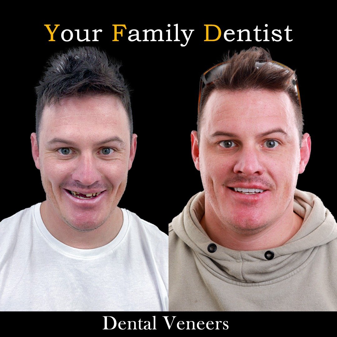 Dental Veneers