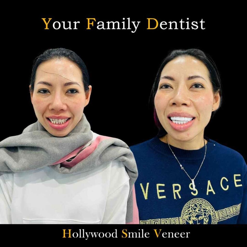 Holywood Smile Veneers