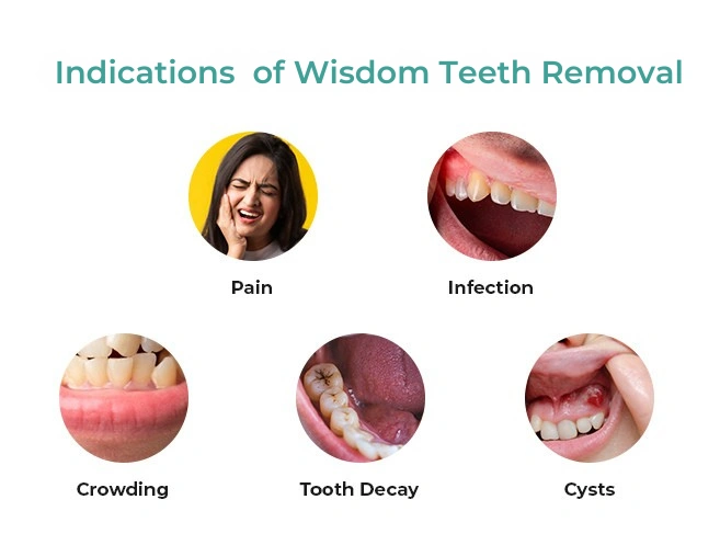Wisdom Tooth Extraction 3 Dental implants Liverpool clinic — Dr Nick Bhayani