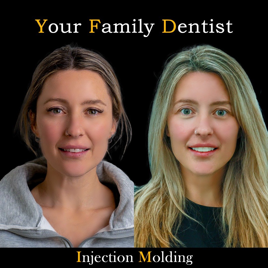 Veneers before and after 2