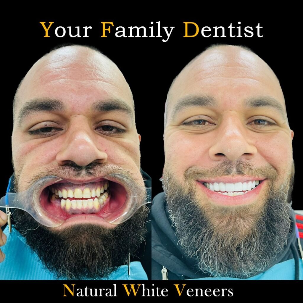 Natural White Veneers