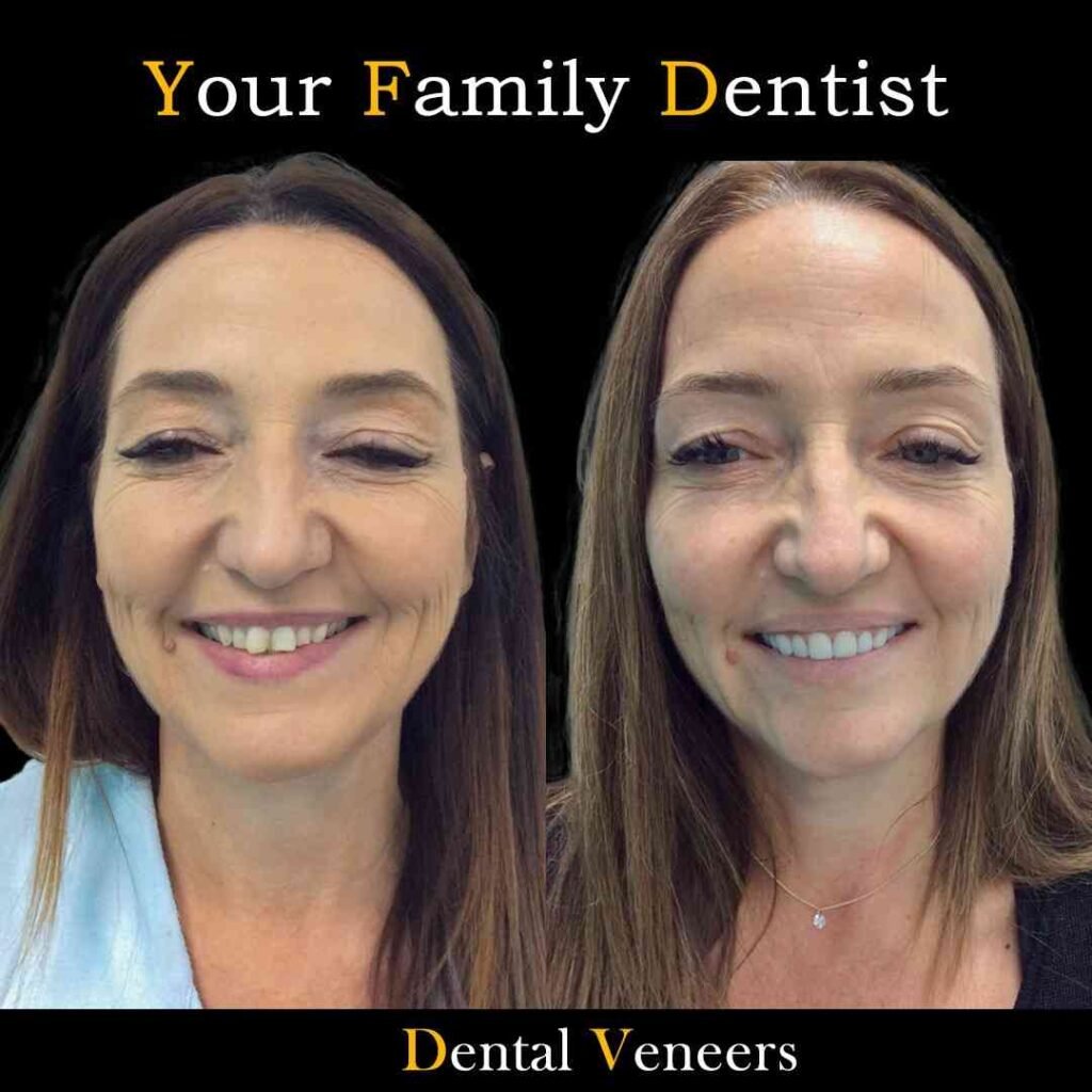 Dental Veneers