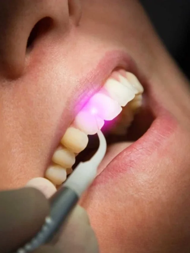 Laser dental technologys helps to replace the traditional dental drill to reduce patient anxiety