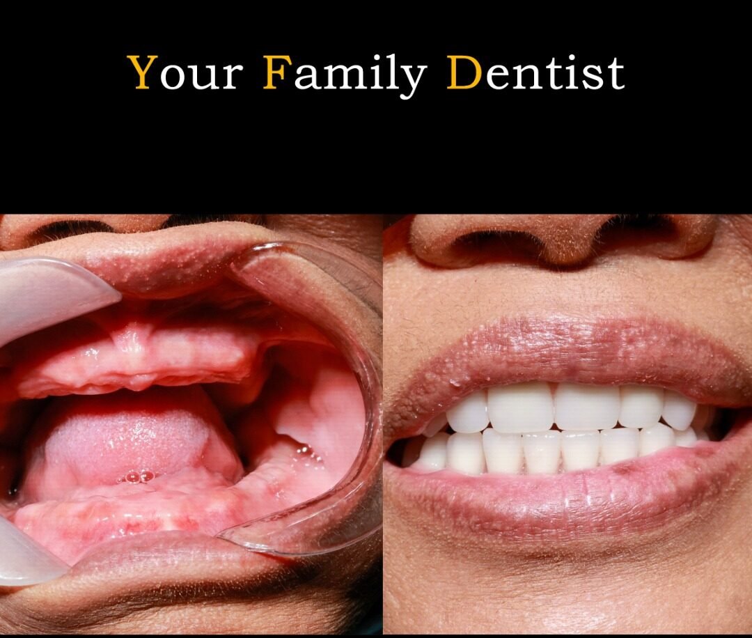 Full-mouth dental implant example