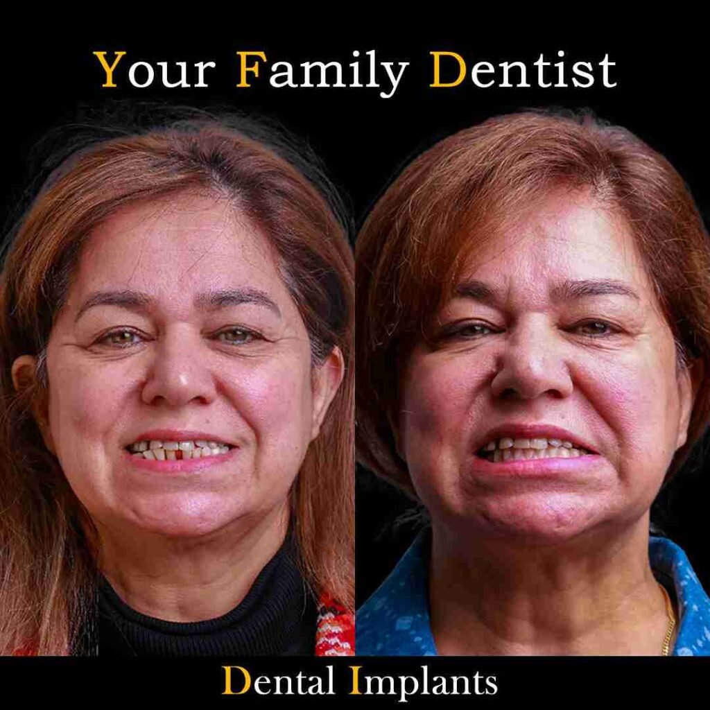 Dental Implants