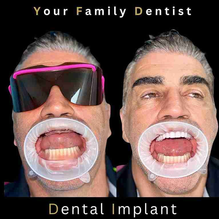 implant