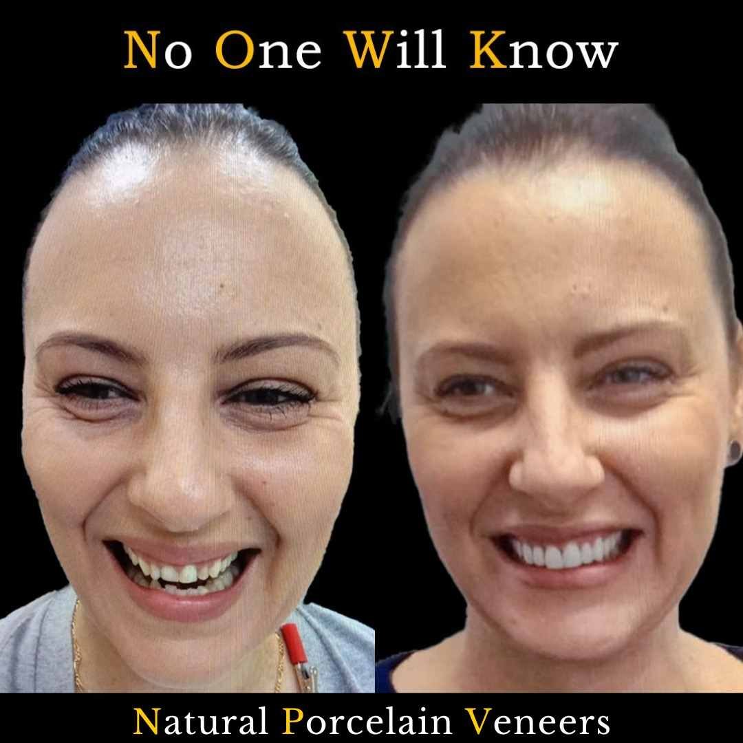 Before and after dental treatment result at Your Family Dentist