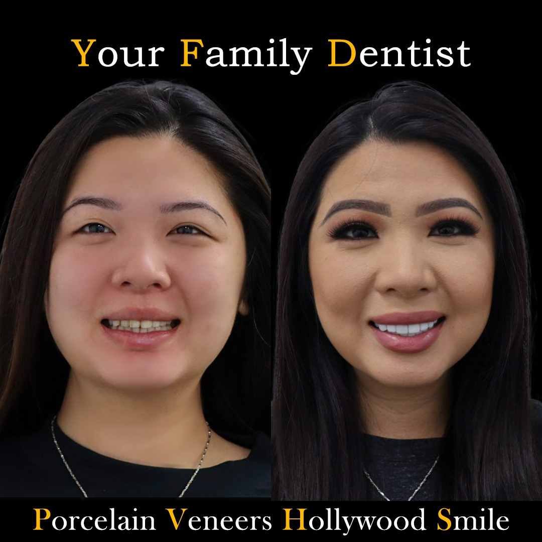 Before and after dental treatment result at Your Family Dentist