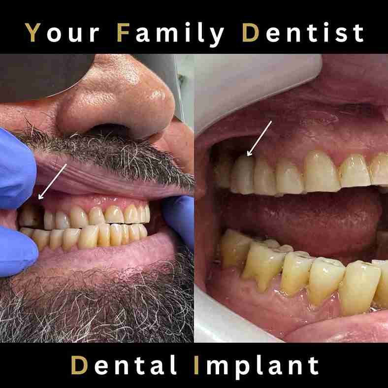 implant