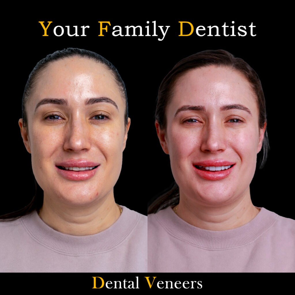 veneers