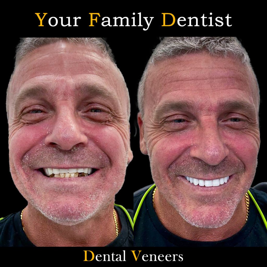 veneers